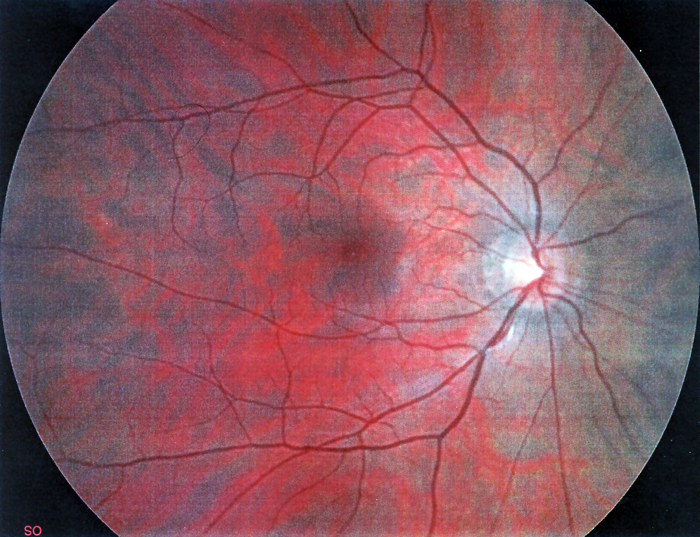 retinografia